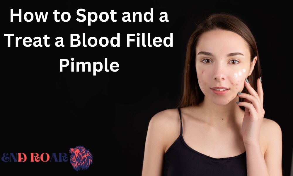 How to Spot and a Treat a Blood Filled Pimple