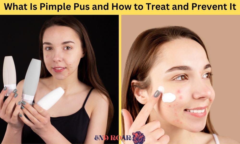 What Is Pimple Pus and How to Treat and Prevent It