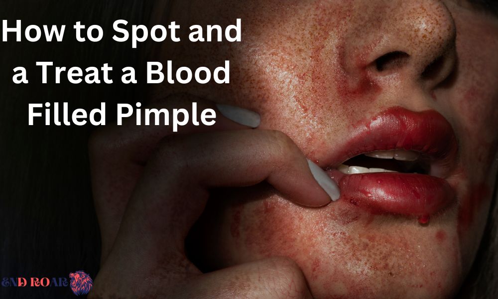 How to Spot and a Treat a Blood Filled Pimple