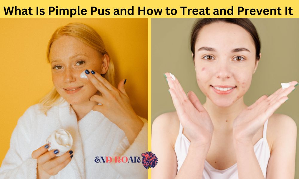 What Is Pimple Pus and How to Treat and Prevent It